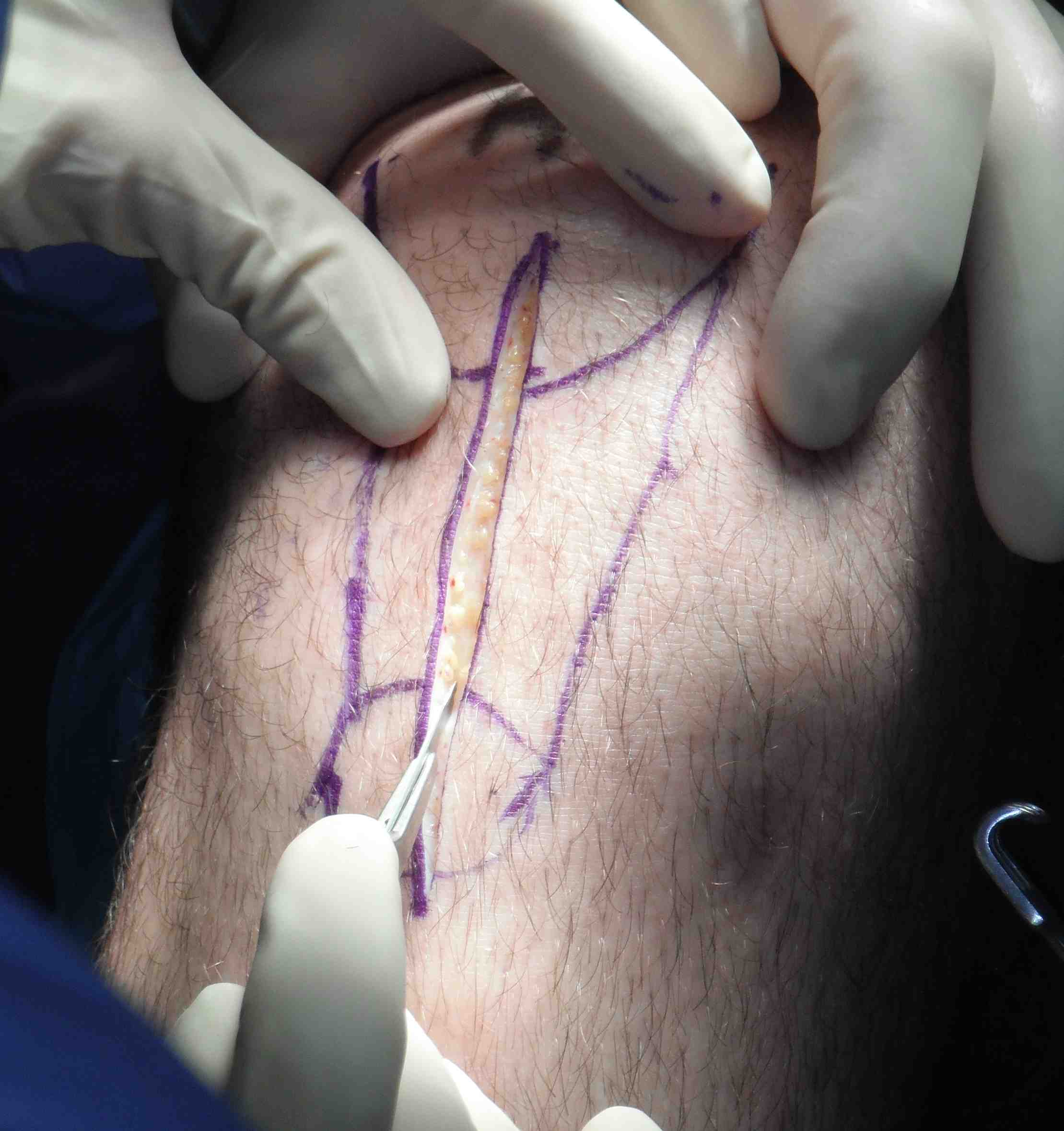 BPTB Incision